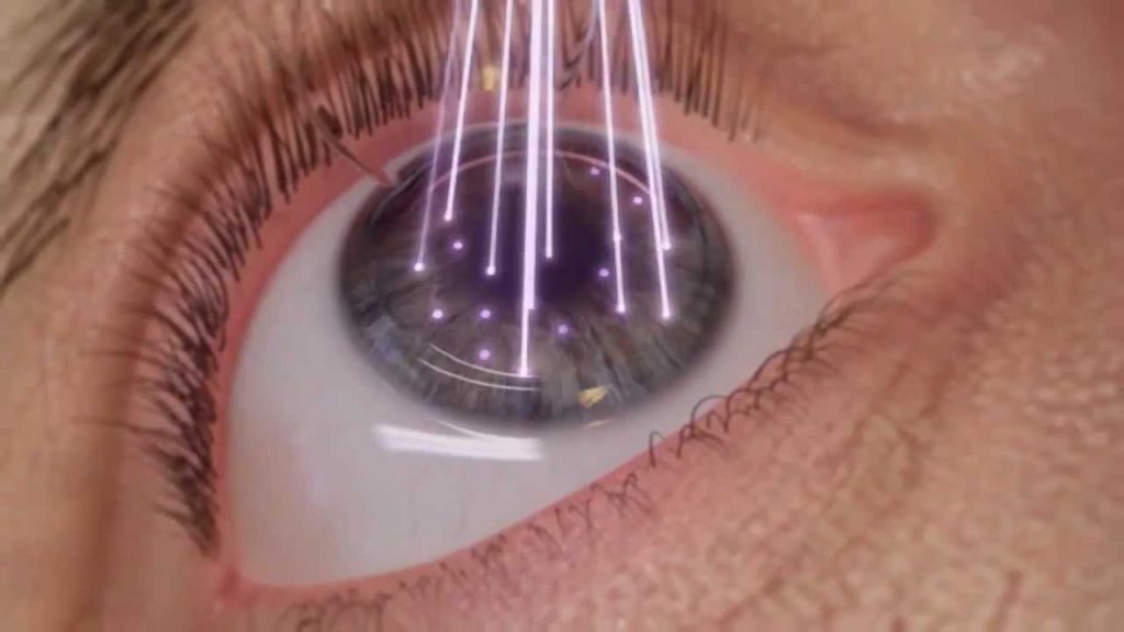 Cirurgia a Laser Personalizada